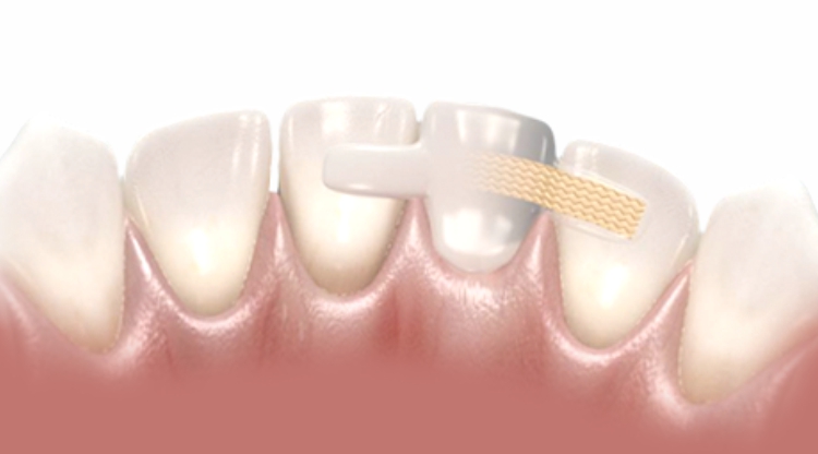 Адгезивное протезирование подойдет только при отсутствии одного зуба Адгезивное протезирование