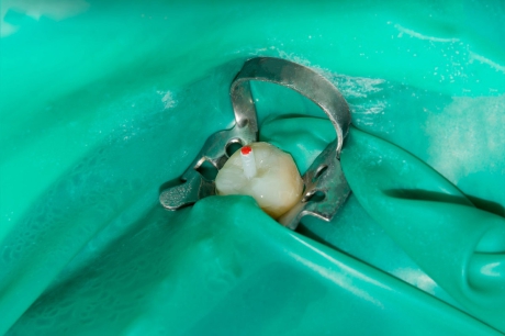 Стекловолоконный штифт позволяет восстановить коронковую часть зуба Имплантация зуба