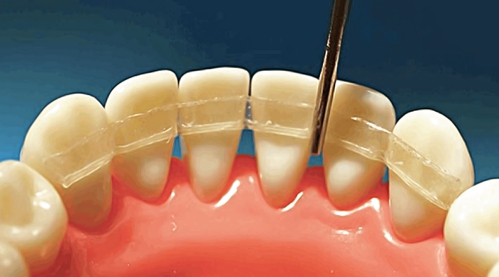 Шинирование при помощи стекловолокна дает возможность сохранить шатающиеся зубы Шинирование при помощи стекловолокна